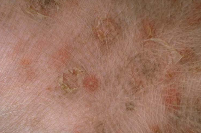 Folliculitis